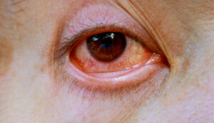 ojos con venas rojas