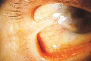 Urgencias oftalmológicas por conjuntivitis