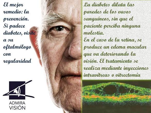 14 de Noviembre: Día Mundial de la Diabetes. Campaña de prevención de la retinopatía diabética
