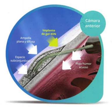 Glaucoma
