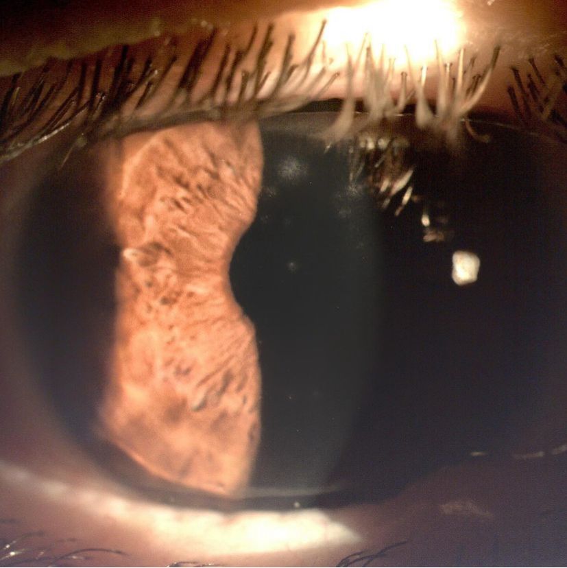 Infiltrados corneales tras una conjuntivitis vírica